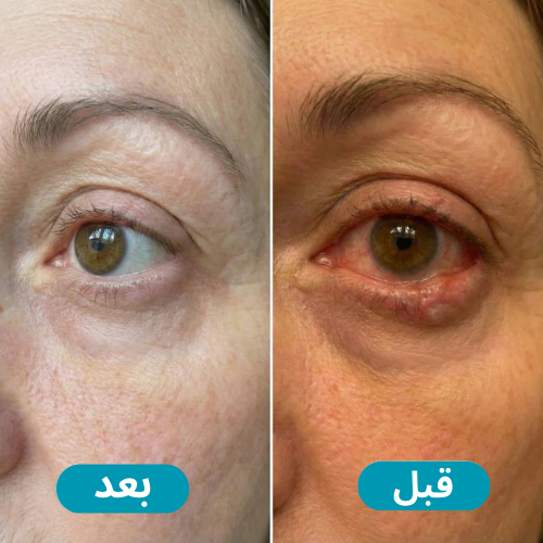 ™OptiCalm-تنعيم و ترطيب فوري لعيونك خلال دقائق